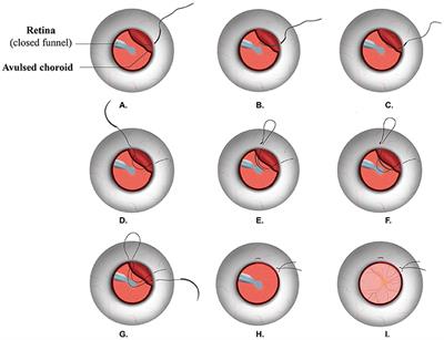 Novel Suturing Methods for the Management of Traumatic Choroidal Avulsion in Globe Injuries